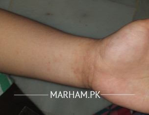 Rashes/blisters