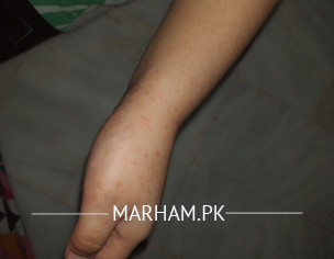 Rashes/blisters