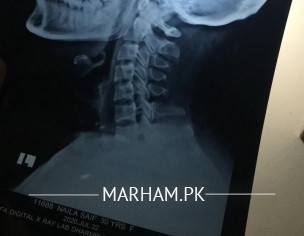 Left Shoulder Pain, Neck To Arm