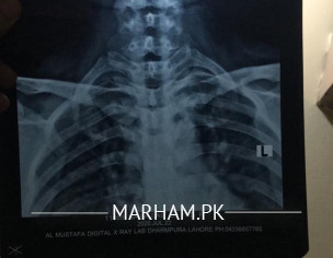 Left Shoulder Pain, Neck To Arm