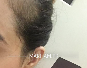 Hairfall Issues