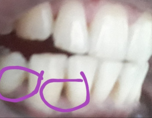 Gum Recession And Spacing Between Teeth