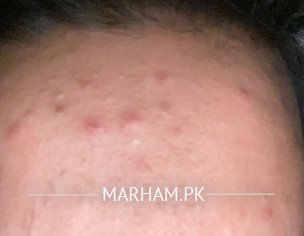 Acne ,pimples Problem 