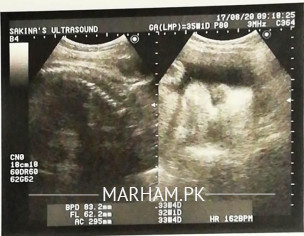 Normal Delivery Or C Section