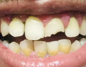 Broken Tooth Treatment 