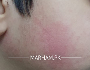 Face Rash