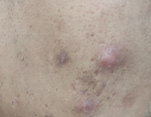 Cyst / Bumps + Scars On Face