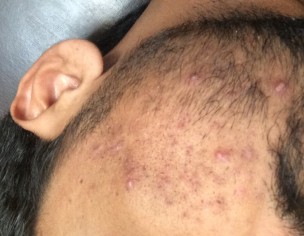 Skin Spots And Pimples