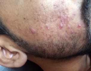 Skin Spots And Pimples