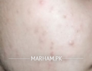 Acne And Acne Marks