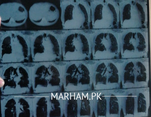 Lungs Disease Current Xray Attached For Suggestions