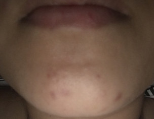 Hormonal Acne