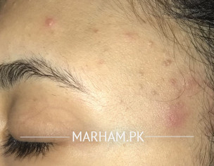 Severe Acne Of All Face