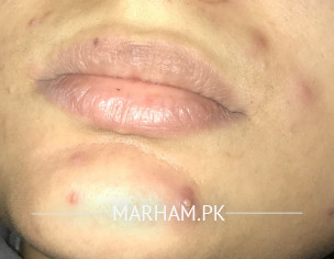 Severe Acne Of All Face