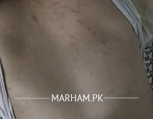 Severe Acne On Back