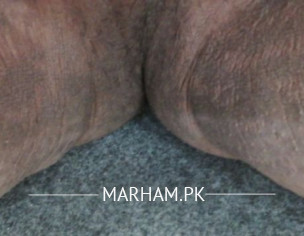 Skin Problem At Secret Area Below Testes