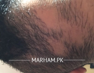 Balding In The Beard Area