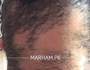 Balding In The Beard Area