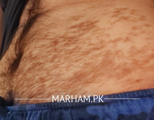 Hyperpigmentation On Belly