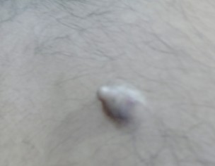 Cyst At My Back