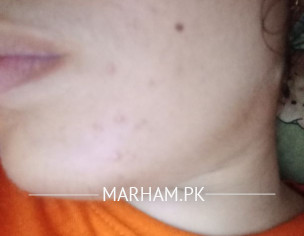 Face Pimples Problem