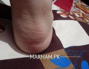 Foot Back Sid Problem