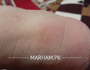 Foot Back Sid Problem