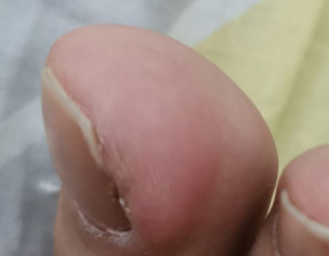 Foot Thumb