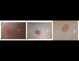 Dermatological Problem