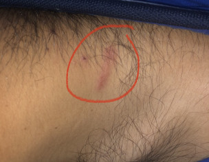 Reddish Rash/insect Bite Type Something 