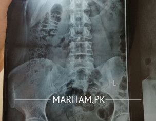 Lower Back Discomfort