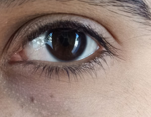 Eye Problem