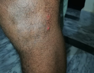 Severe Itching On Legs