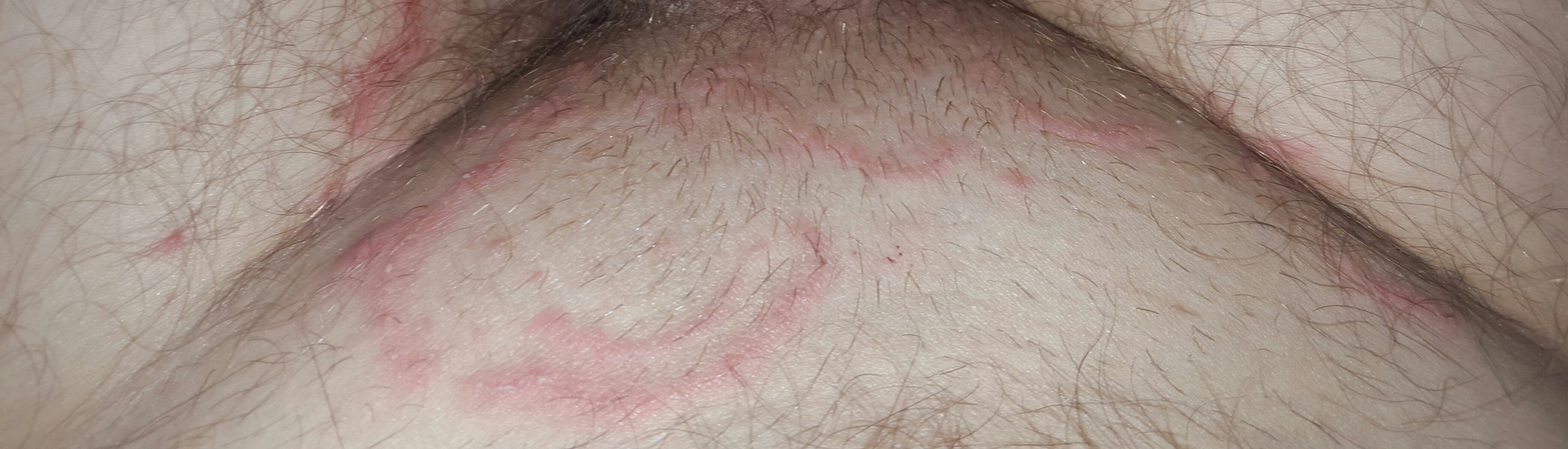 Rash on Inner Thigh Female