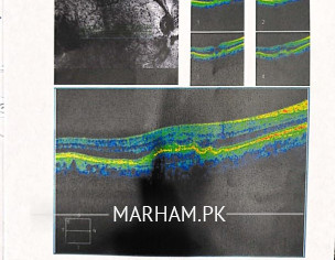 Right Eye Retinal Problem