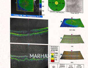 Right Eye Retinal Problem