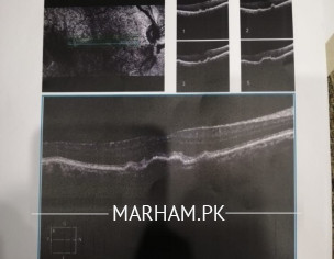 Right Eye Retinal Problem