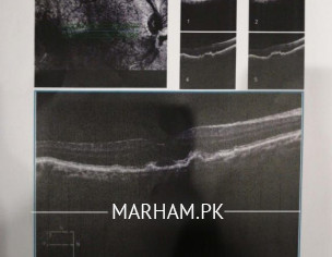 Right Eye Retinal Problem