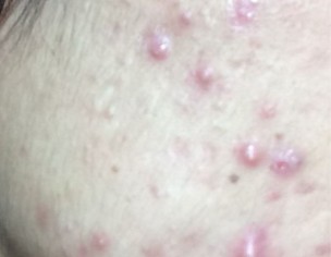 Severe Acne