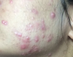 Severe Acne