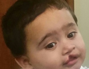 CLEFT LIP