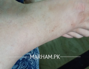 Marks On Foot