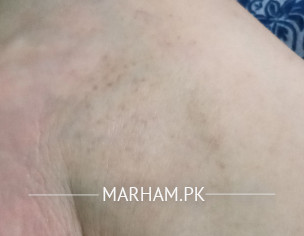 Marks On Foot