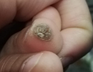 Is This Wart?