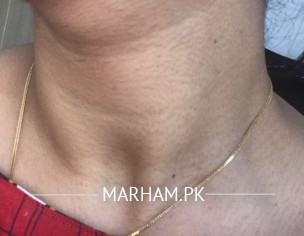 Marks On Neck And Arms