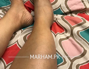 Swelling In The Right Leg 