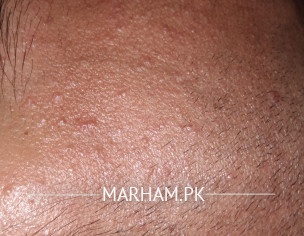 Acne, Skin, Dandruff