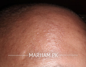 Acne, Skin, Dandruff