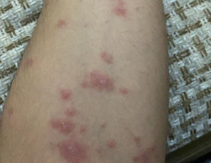 Red Spots On Body 