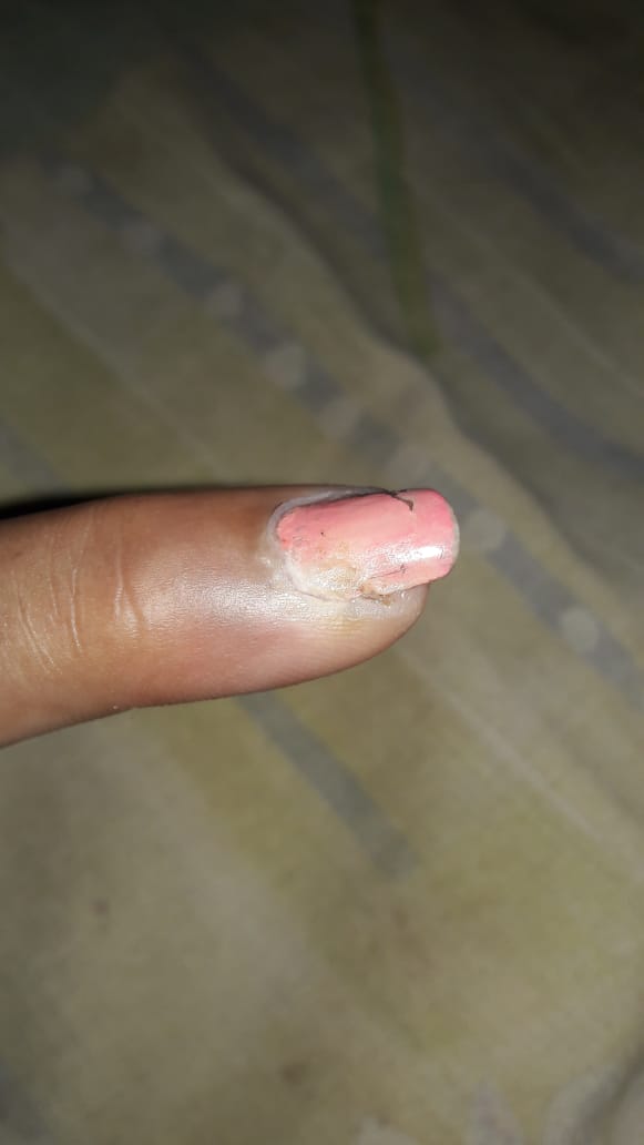 Nail Problems | Illinois Dermatology Institute